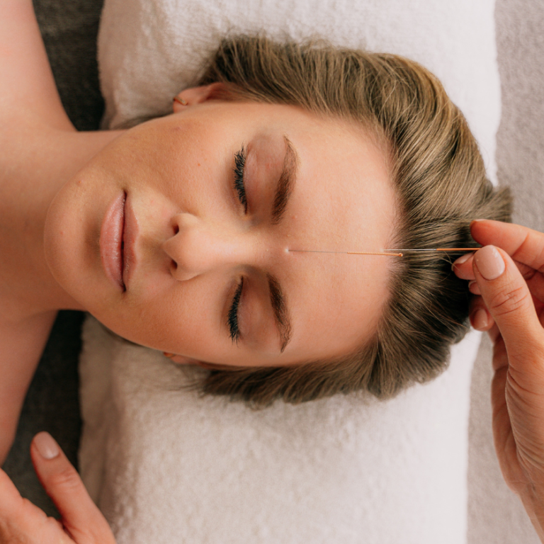 Acupuncture Services in Long Beach