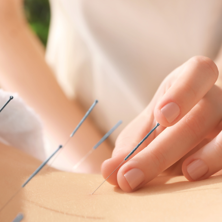 Acupuncture Services in Seal Beach